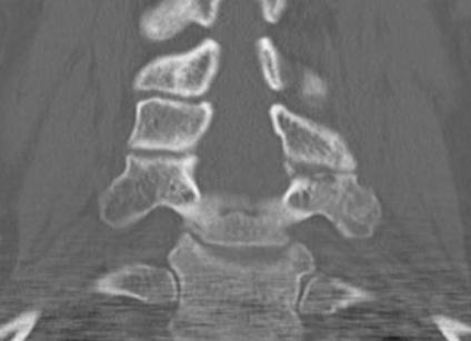 Cervical Superior Articular Facet Fracture0001